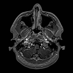 File:Cochlear incomplete partition type III associated with hypothalamic hamartoma (Radiopaedia 88756-105498 Axial T1 C+ 37).jpg