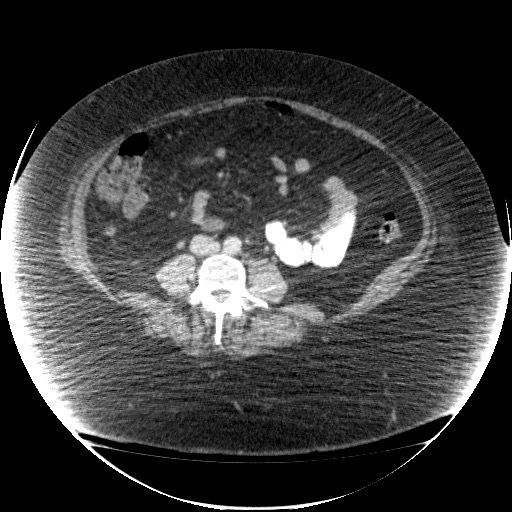 File:Collection due to leak after sleeve gastrectomy (Radiopaedia 55504-61972 A 49).jpg
