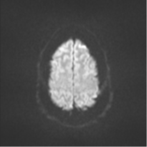 File:Colloid cyst (Radiopaedia 53164-59125 Axial DWI 52).png