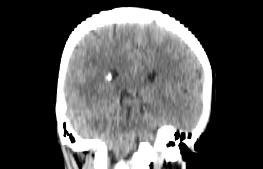 Colloid cyst (Radiopaedia 88663-105373 Coronal non-contrast 45).jpg