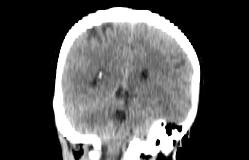 Colloid cyst (Radiopaedia 88663-105373 Coronal non-contrast 47).jpg