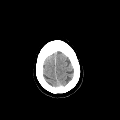 Colloid cyst (large) (Radiopaedia 34415-35734 Axial non-contrast 52).png
