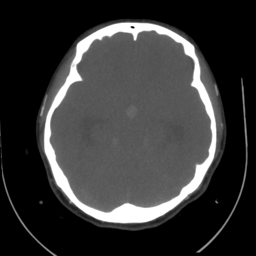 File:Colloid cyst (resulting in death) (Radiopaedia 33423-34499 A 23).png