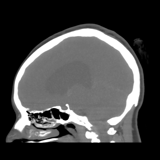 File:Colloid cyst (resulting in death) (Radiopaedia 33423-34499 B 26).png