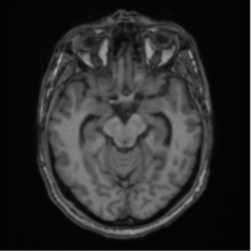 File:Colloid cyst of the third ventricle (Radiopaedia 86571-102662 Axial T1 32).png