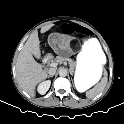 File:Colocolic intussusception due to large lipoma (Radiopaedia 68773-78482 A 44).jpg