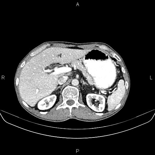 Colon adenocarcinoma - hepatic flexure (Radiopaedia 85635-101395 A 25).jpg