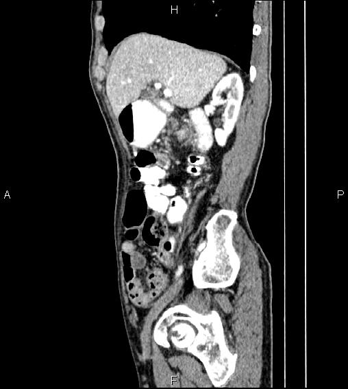 Colon adenocarcinoma - hepatic flexure (Radiopaedia 85635-101395 D 26).jpg