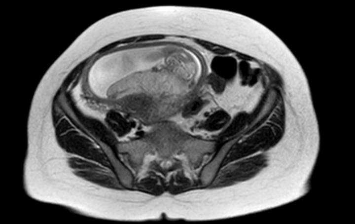 Colon adenocarcinoma with Krukenberg tumors, advanced pregnancy (Radiopaedia 67279-76645 Axial T2 24).jpg