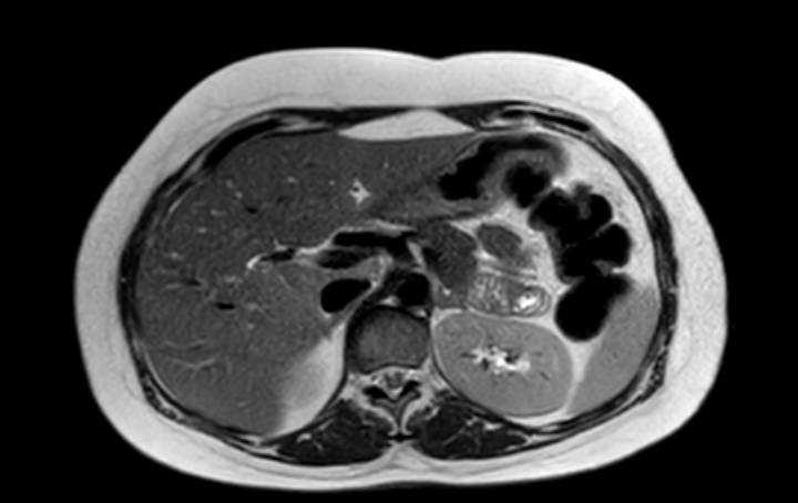 File:Colon adenocarcinoma with Krukenberg tumors, advanced pregnancy (Radiopaedia 67279-76645 Axial T2 62).jpg