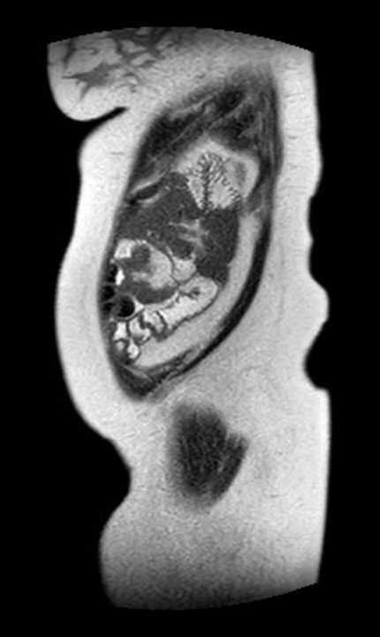 Colon adenocarcinoma with Krukenberg tumors, advanced pregnancy (Radiopaedia 67279-76645 Sagittal T2 5).jpg