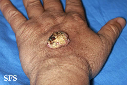 File:Keratoacanthoma (Dermatology Atlas 46).jpg