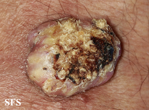 File:Keratoacanthoma (Dermatology Atlas 51).jpg