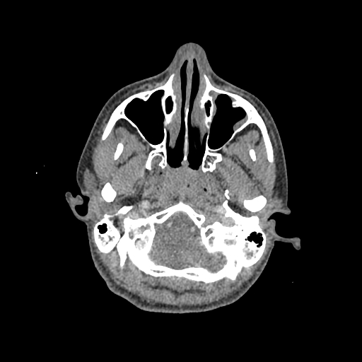 Nasal pyogenic granuloma (lobular capillary hemangioma) (Radiopaedia 85536-101244 C 55).jpg