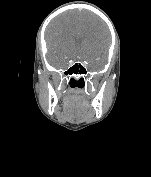 File:Nasal pyogenic granuloma (lobular capillary hemangioma) (Radiopaedia 85536-101244 D 58).jpg