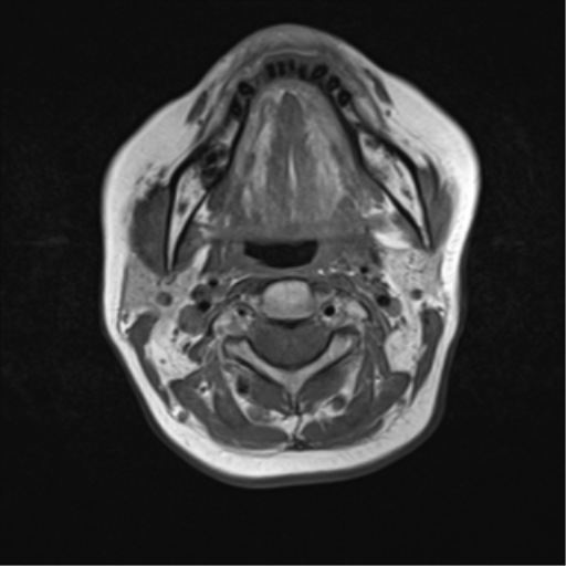 File:Nasopharyngeal carcinoma with cerebral abscess (Radiopaedia 43018-46273 Axial T1 28).png