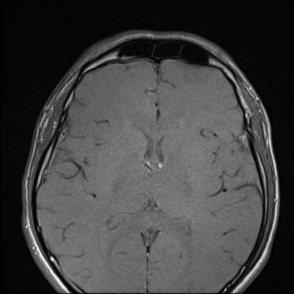 File:Nasopharyngeal carcinoma with skull base invasion (Radiopaedia 53415-59485 Axial T1 7).jpg