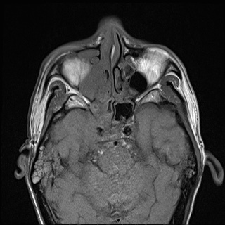 File:Nasopharyngeal carcinoma with skull base invasion (Radiopaedia 59258-66600 B 11).jpg