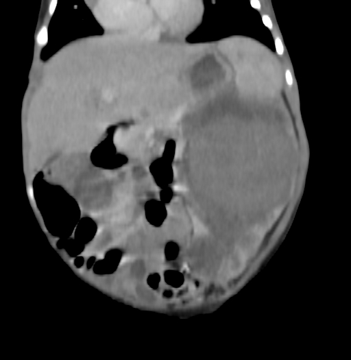 Nephroblastomatosis (Radiopaedia 71294-81607 B 152).jpg