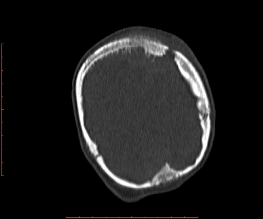 File:Neuroblastoma skull metastasis (Radiopaedia 56053-62683 Coronal bone window 39).jpg