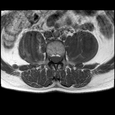 File:Neurofibromatosis type 1- extensive spinal involvement and Christmas tree sign (Radiopaedia 60610-68332 Axial T1 23).jpg