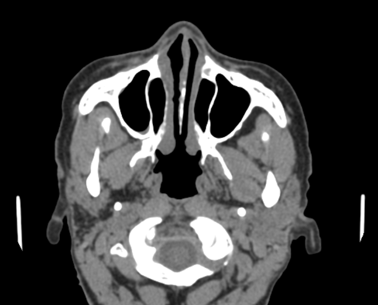 Neurofibromatosis type 1- orbital manifestations (Radiopaedia 49391-54511 Axial non-contrast 24).jpg