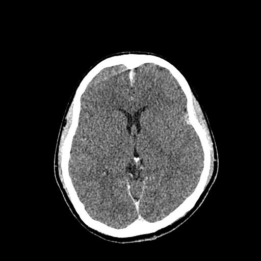 File:Neurofibromatosis type 2 (Radiopaedia 25389-25637 Axial C+ 46).jpg