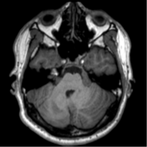 File:Neurofibromatosis type 2 (Radiopaedia 44936-48838 Axial T1 33).png
