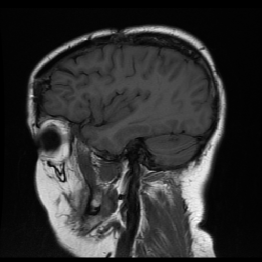File:Neurofibromatosis type 2 (Radiopaedia 45229-49251 Sagittal T1 16).png