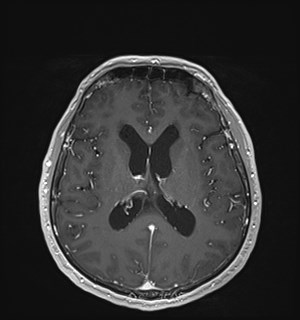 Neurofibromatosis type 2 (Radiopaedia 79097-92049 Axial T1 C+ 114).jpg