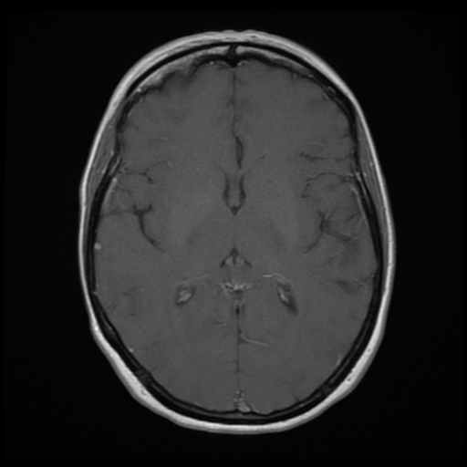 File:Neurofibromatosis type 2 - bilateral acoustic neuromata (Radiopaedia 40060-42566 Axial T1 C+ 11).png