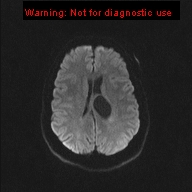File:Neuroglial cyst (Radiopaedia 10713-11184 Axial DWI 32).jpg