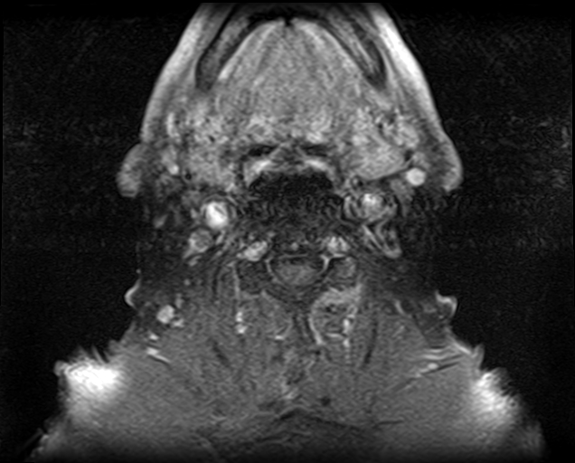 File:Non-Hodgkin lymphoma - parotid gland (Radiopaedia 71531-81890 Axial T1 C+ fat sat 6).jpg