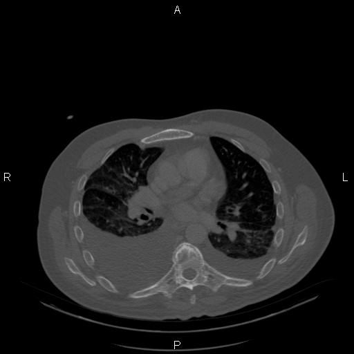 Non Hodgkin lymphoma in a patient with ankylosing spondylitis (Radiopaedia 84323-99624 Axial bone window 15).jpg
