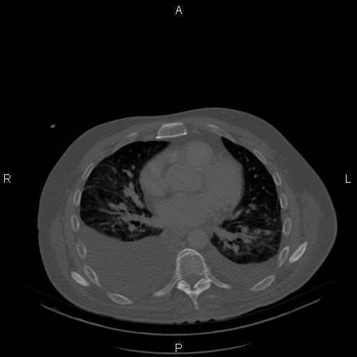 Non Hodgkin lymphoma in a patient with ankylosing spondylitis (Radiopaedia 84323-99624 Axial bone window 17).jpg