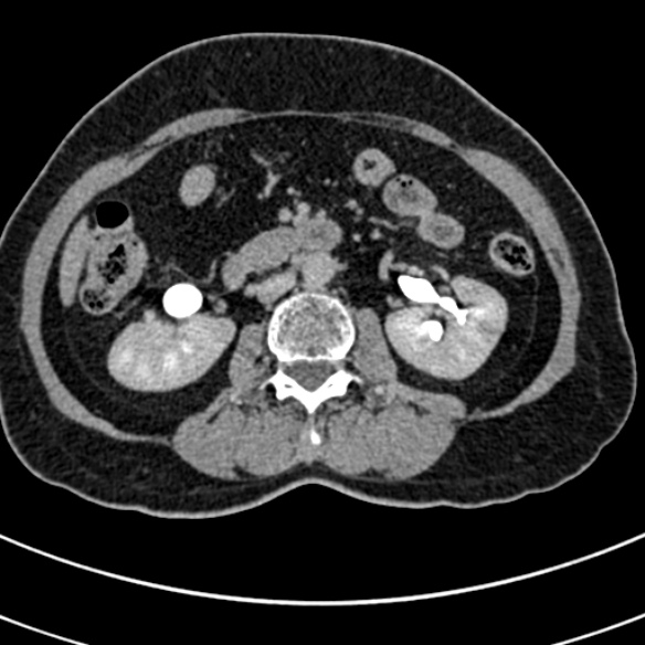 File:Normal CT split bolus study of the renal tract (Radiopaedia 48631-53634 Axial split bolus 99).jpg