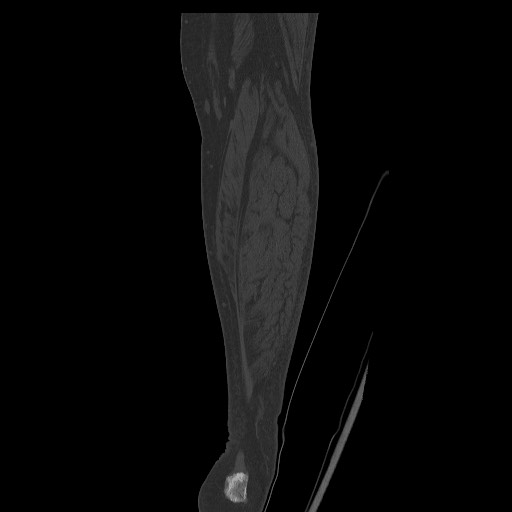 Normal CT tibia and fibula (Radiopaedia 51195-56848 Coronal non-contrast 57).jpg