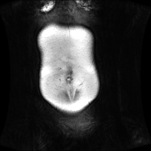 Normal MRI abdomen in pregnancy (Radiopaedia 88001-104541 N 20).jpg