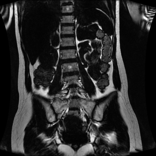 Normal MRI abdomen in pregnancy (Radiopaedia 88001-104541 N 91).jpg