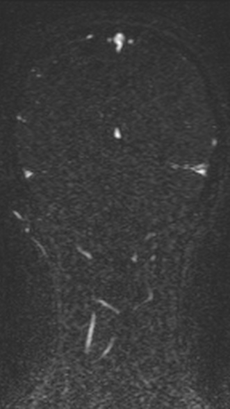 Normal MRI brain with MRV- teenager (Radiopaedia 49425-54553 Coronal MRV 186).jpg