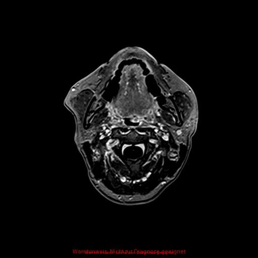 Normal adult brain MRI (non-enhanced and contrast-enhanced) (Radiopaedia 75262-86379 Axial T1 C+ 14).jpg