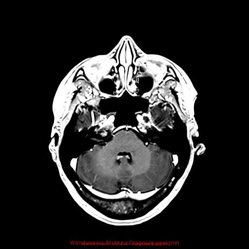 Normal adult brain MRI (non-enhanced and contrast-enhanced) (Radiopaedia 75262-86379 Axial T1 C+ 70).jpg