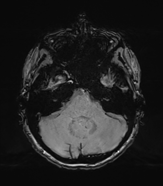 Normal brain MRI (TLE protocol) (Radiopaedia 40748-43405 Axial SWI 20).png
