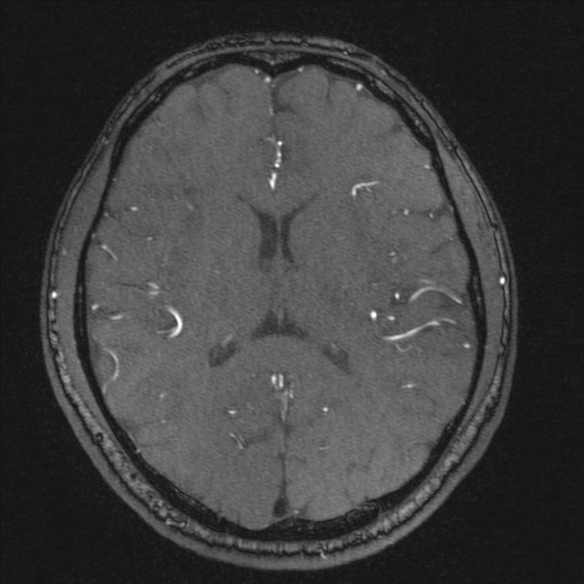 Normal brain MRI including MRA (Radiopaedia 48748-53763 Axial MRA 128).jpg