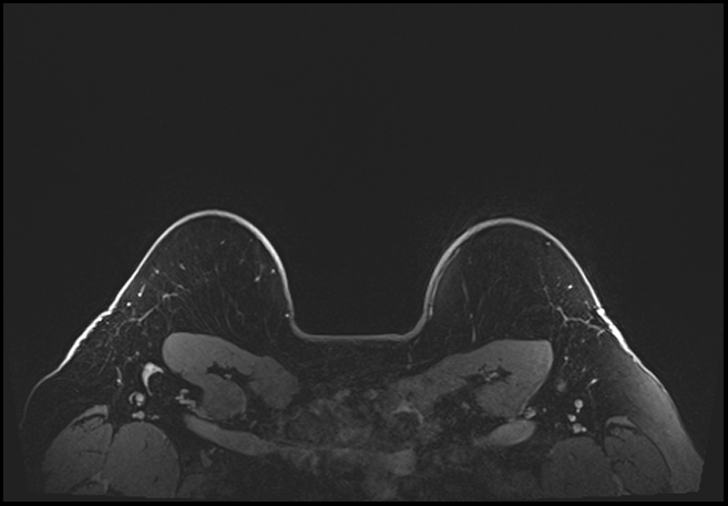 Normal breast MRI - dense breasts (Radiopaedia 80454-93850 C 206).jpg