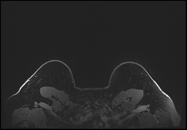 Normal breast MRI - dense breasts (Radiopaedia 80454-93850 C 219).jpg