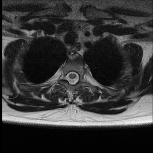 File:Normal cervical and thoracic spine MRI (Radiopaedia 35630-37156 H 37).png