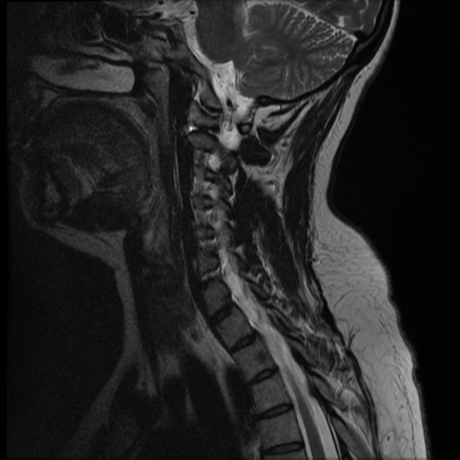 File:Normal cervical and thoracic spine MRI (Radiopaedia 35630-37156 Sagittal T2 9).png