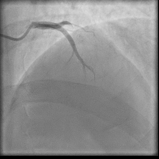 Normal coronary angiogram (DSA) (Radiopaedia 63081-71571 E 17).jpg