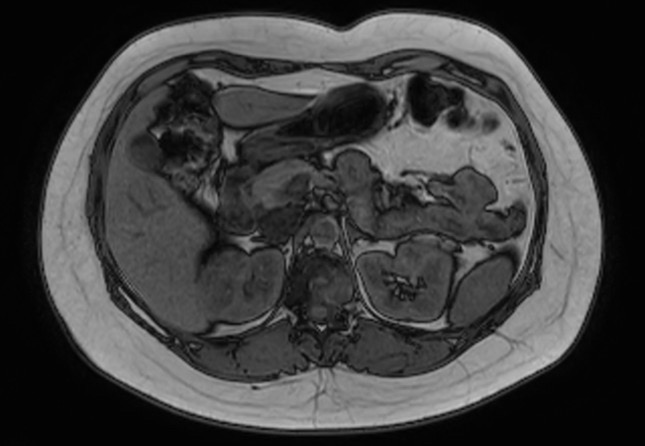 File:Normal liver MRI with Gadolinium (Radiopaedia 58913-66163 B 18).jpg